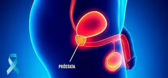 Câncer de próstata matou 17 mil brasileiros em 2023