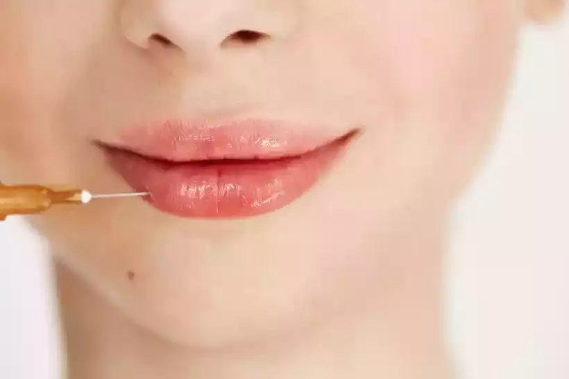 Preenchimento labial: especialista alerta sobre cuidados necessários