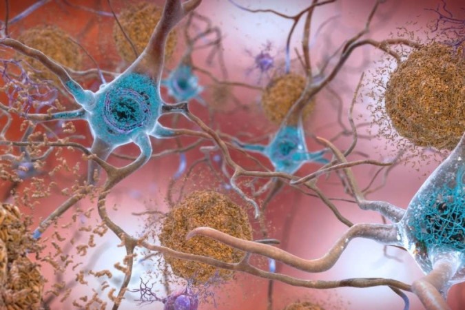 Pesquisa mostra que medicamentos para tratar câncer podem ser eficazes contra o Alzheimer