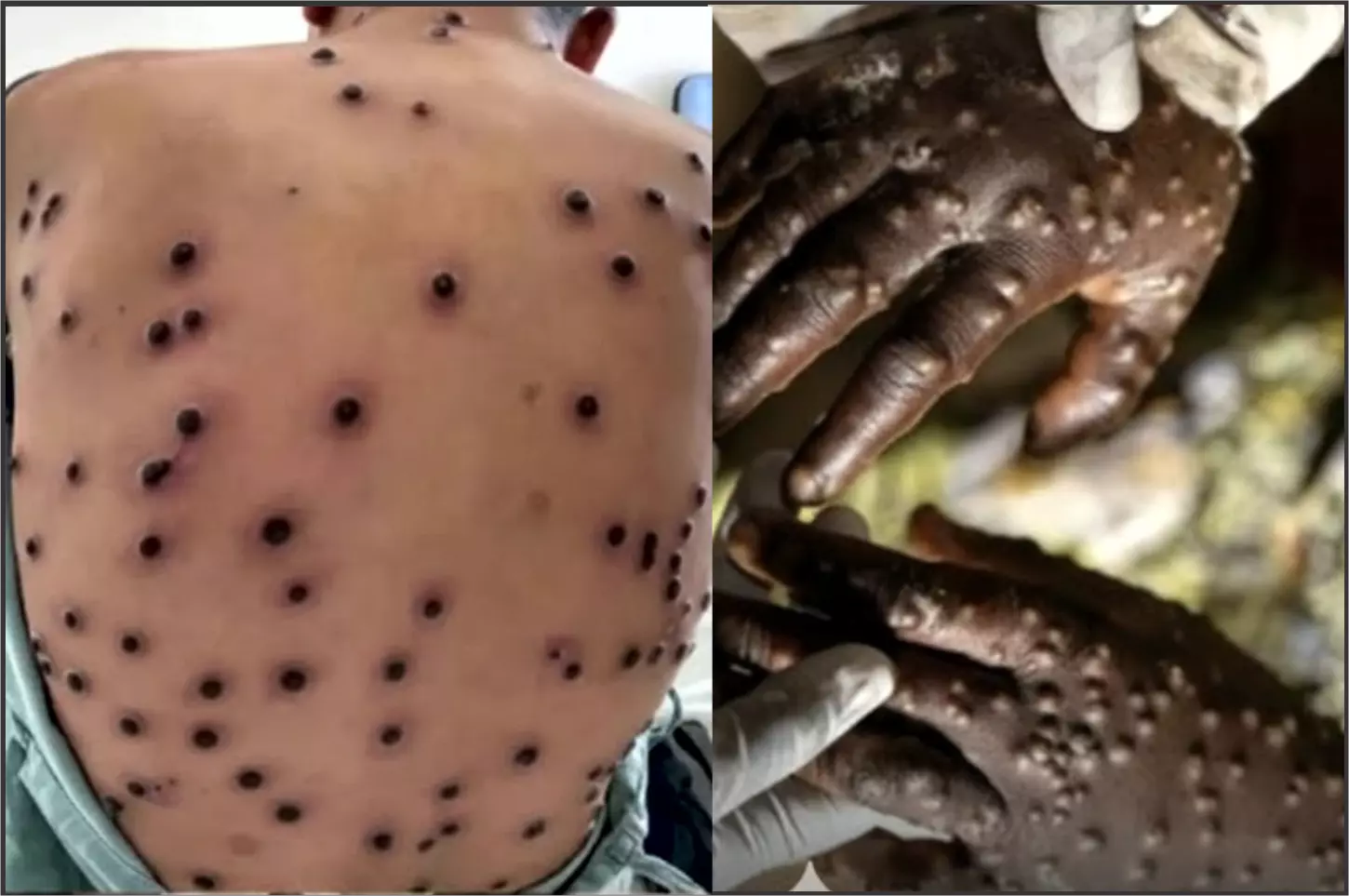 Saúde - Primeiro caso de Mpox é identificado em Araraquara